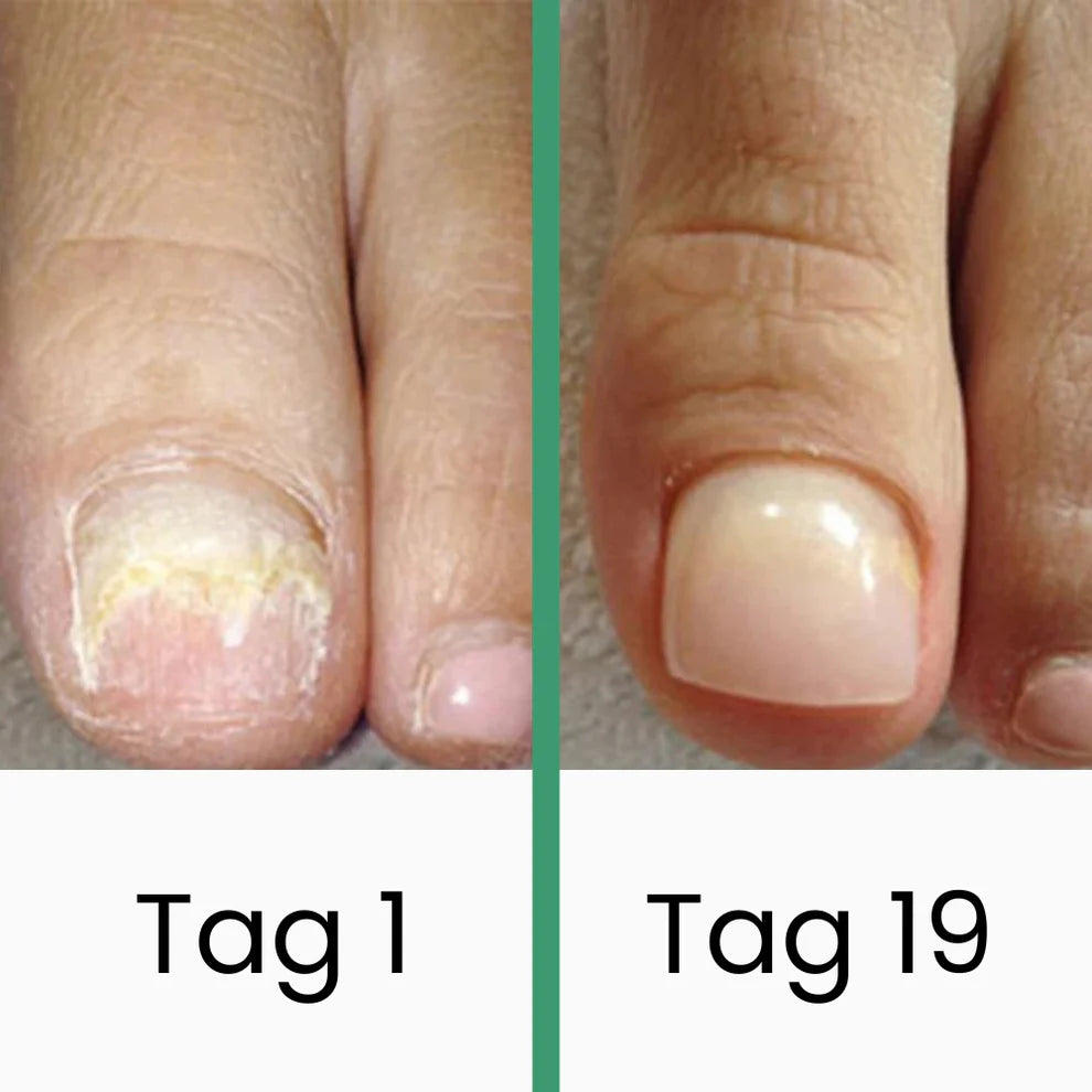 PODOlight® | LLLT-Nagelpilztherapie