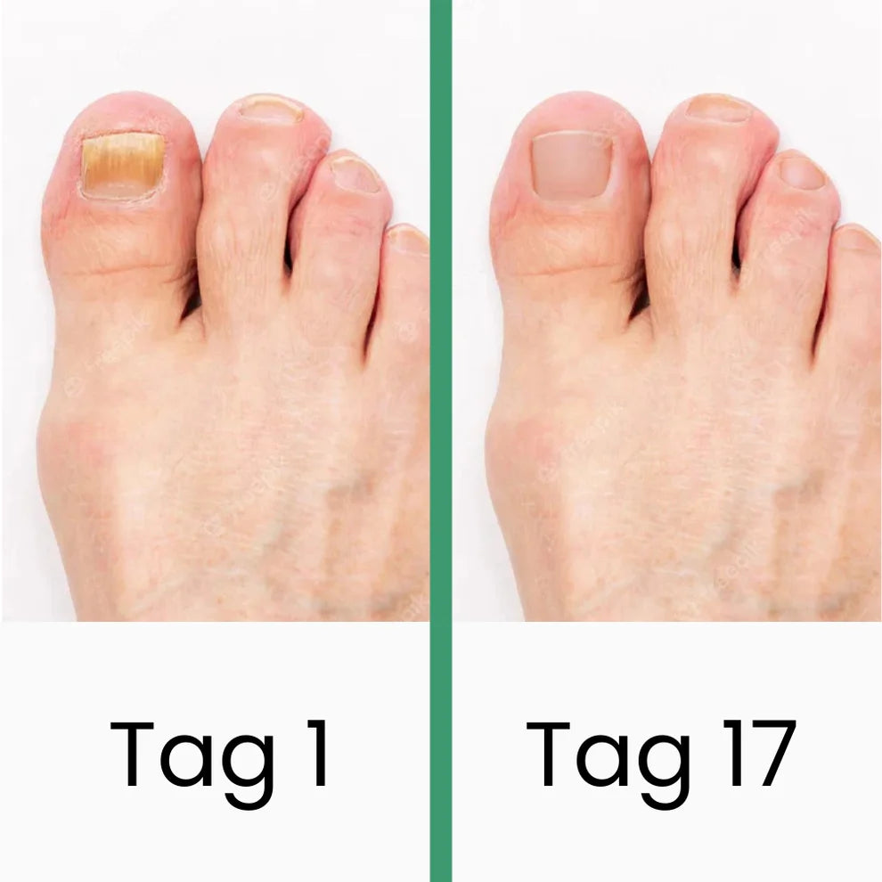 PODOlight® | LLLT-Nagelpilztherapie