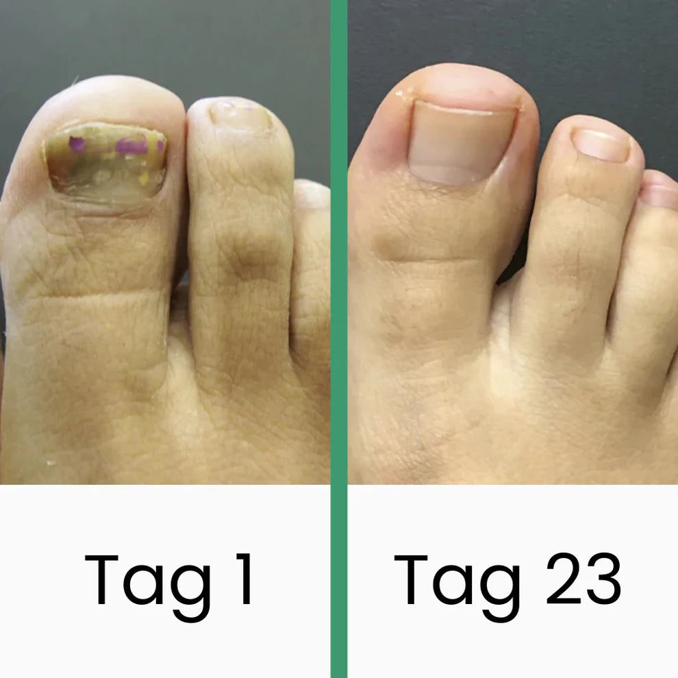 PODOlight® | LLLT-Nagelpilztherapie
