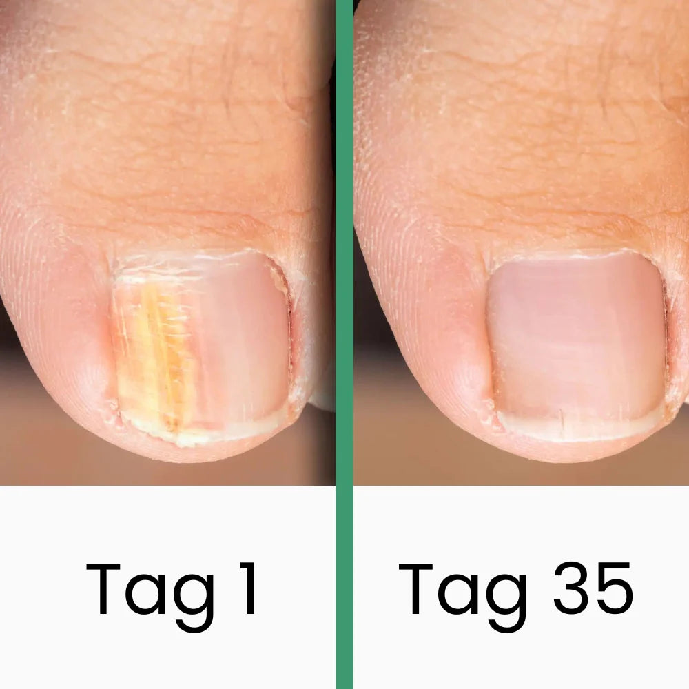PODOlight® | LLLT-Nagelpilztherapie