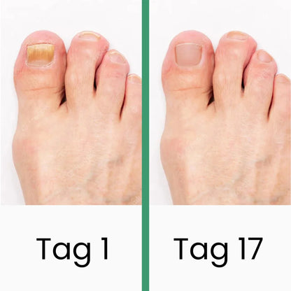 PODOclear® | LLLT-Nagelpilztherapie