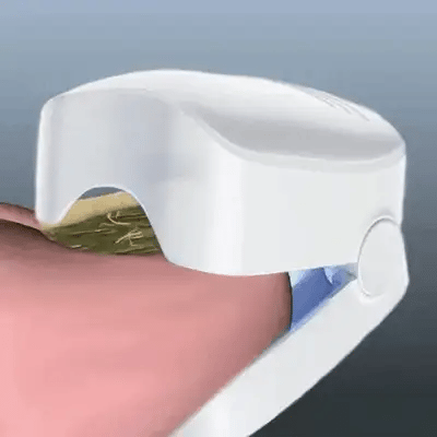PODOclear® | LLLT-Nagelpilztherapie